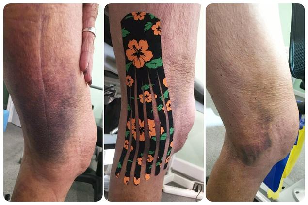 Bruised knee with orange floral kinesiology tape applied, shown from three angles