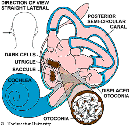 Diagram of the inner ear showing the cochlea, utricle, saccule, semi-circular canals, and displaced otoconia